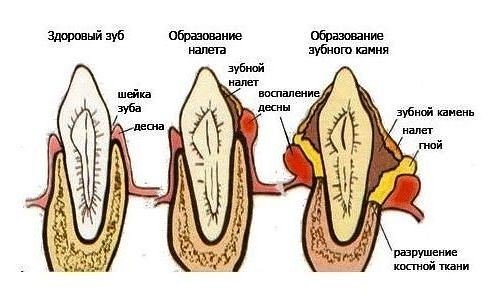 Образование зубного камня и последствия